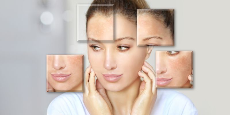 10 Cách trị nám da mặt, tay tại nhà an toàn hiệu quả