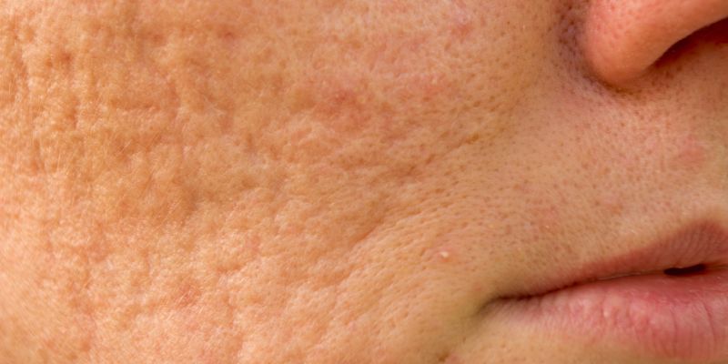 5 cách điều trị sẹo rỗ hiệu quả được yêu thích nhất hiện nay