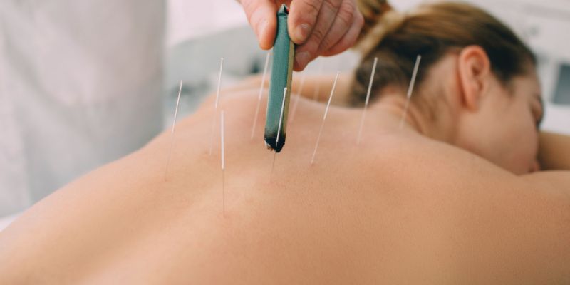 Châm cứu truyền thống – hiện đại