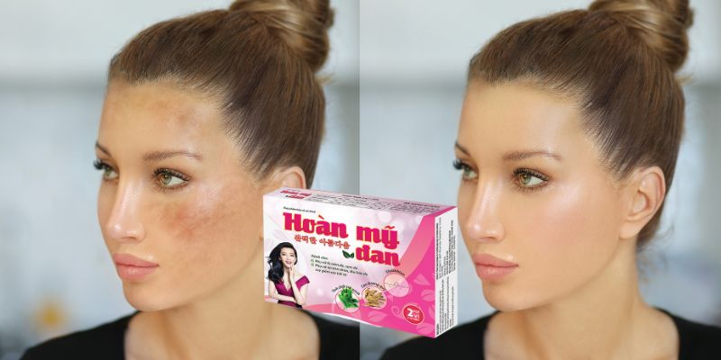 Giải pháp trị nám da mặt bằng thảo dược tự nhiên kết hợp trong Hoàn Mỹ Đan