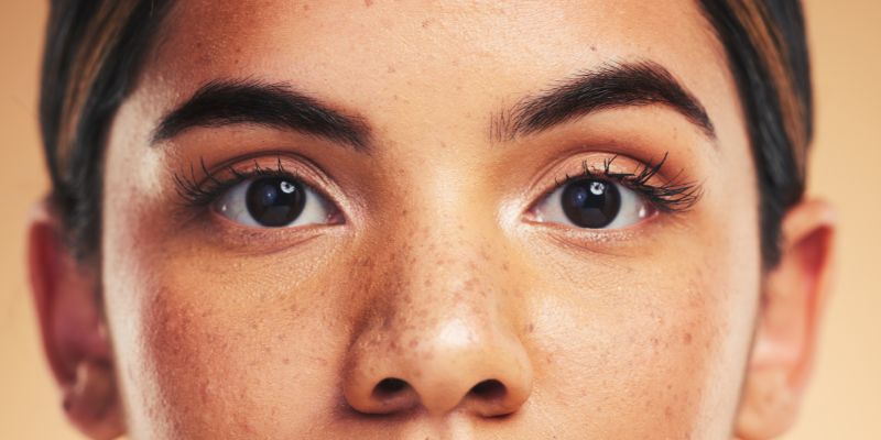 Nám da hình thành do đâu?