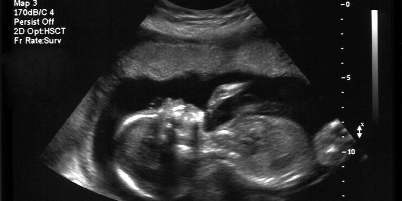 Mẹo & Chăm sóc khi mang thai 34 tuần