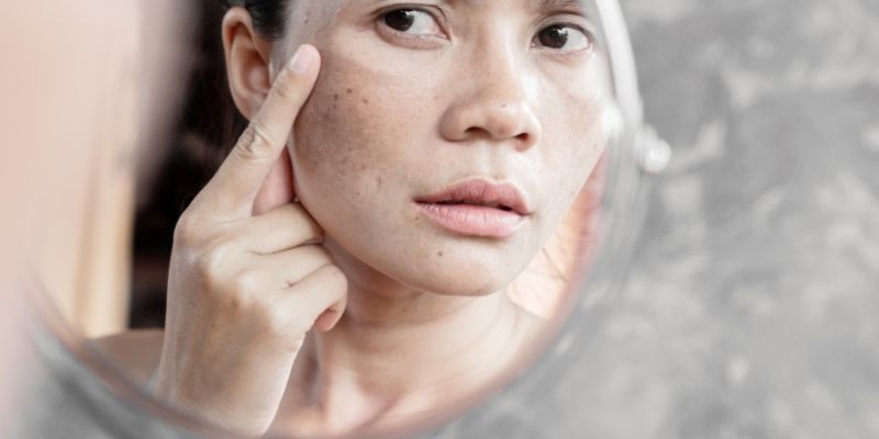 Vì sao mẹ bầu thường dễ bị nám da?