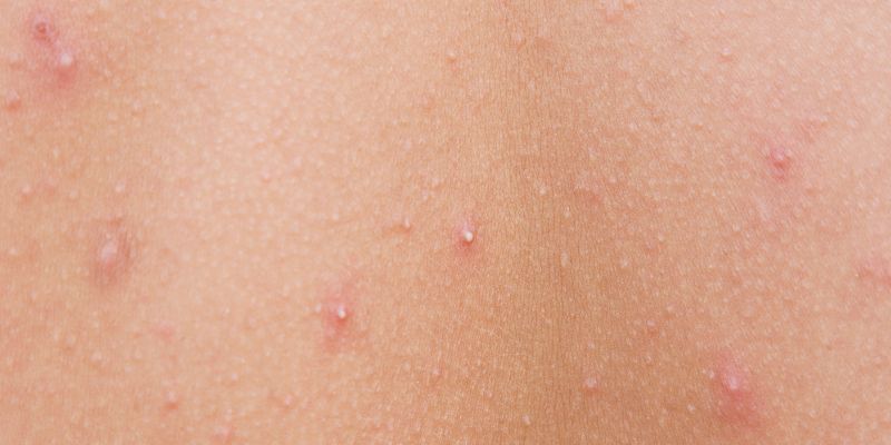 Mụn đầu trắng là gì?