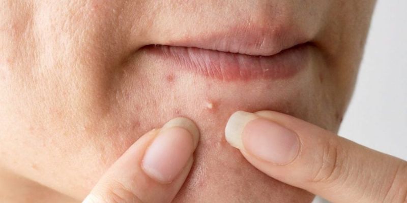 Mụn đầu trắng là gì? Nguyên nhân và cách điều trị như thế nào?