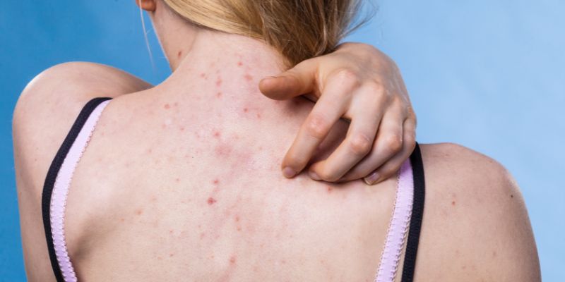 Mụn lưng lâu năm chữa có khó không? Tuyệt chiêu trị mụn lưng