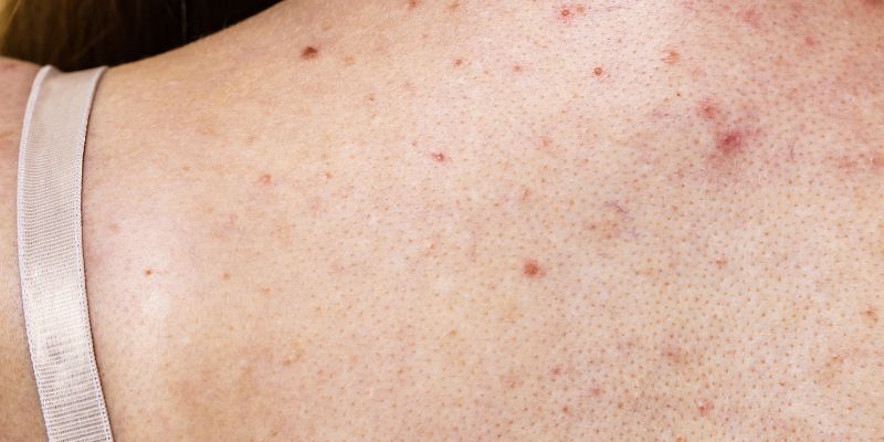 Mụn lưng lâu năm chữa có khó không?