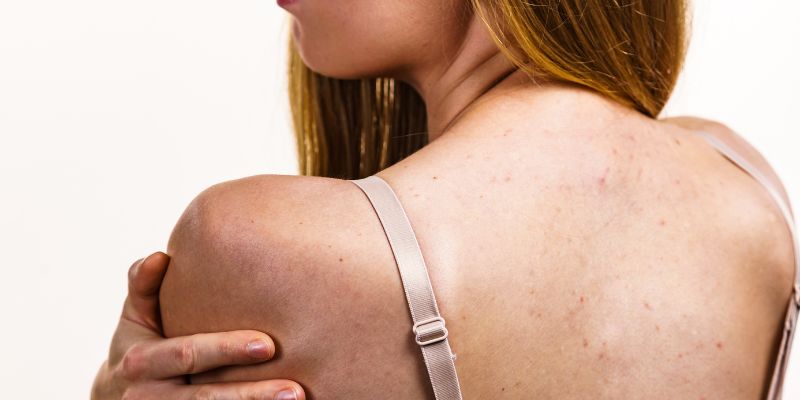 Tại sao mụn lại hay xuất hiện ở lưng?