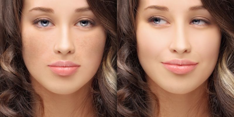 Hiểu đúng về các loại nám da mặt vùng má để có cách trị đúng