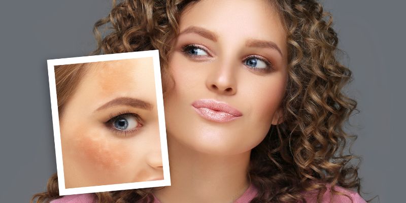 Nám da mặt vùng má và những nguyên nhân gây bệnh phổ biến