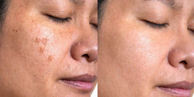 review-hoan-my-dan-co-tot-khong-co-hieu-qua-trong-tri-mun-nam