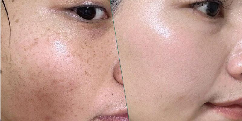 review-hoan-my-dan-co-tot-khong-co-hieu-qua-trong-tri-mun-nam