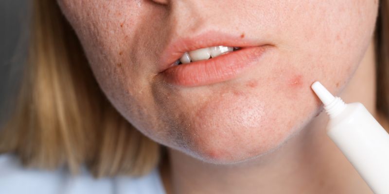 Tổng hợp 5 Thuốc trị mụn hiệu quả tốt nhất từ bác sĩ