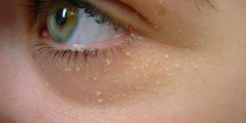 Nguyên nhân gây mụn gạo