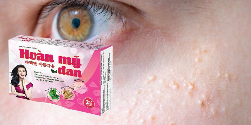 Đánh bay mụn gạo bằng thuốc uống Hoàn Mỹ Đan