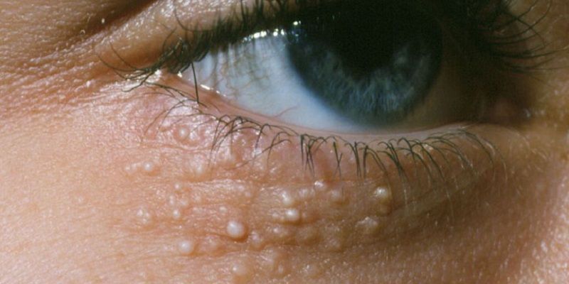 Trị mụn gạo bằng cách nào nhanh chóng và hiệu quả nhất hiện nay?