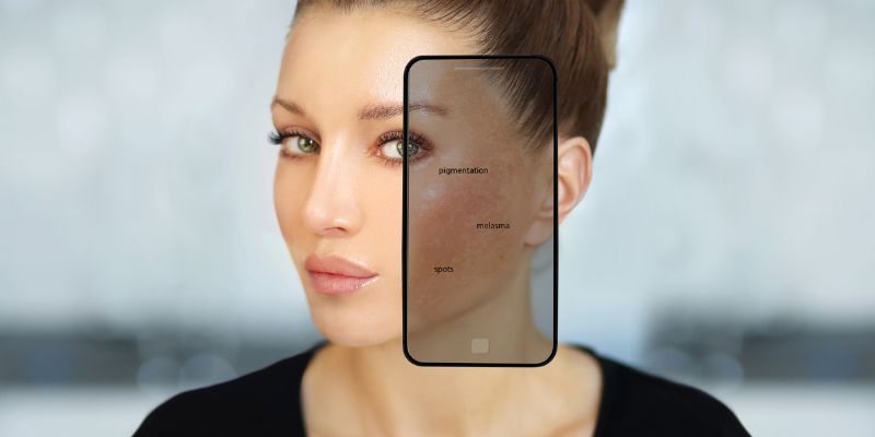 Điều trị nám da vùng miệng từ bên ngoài