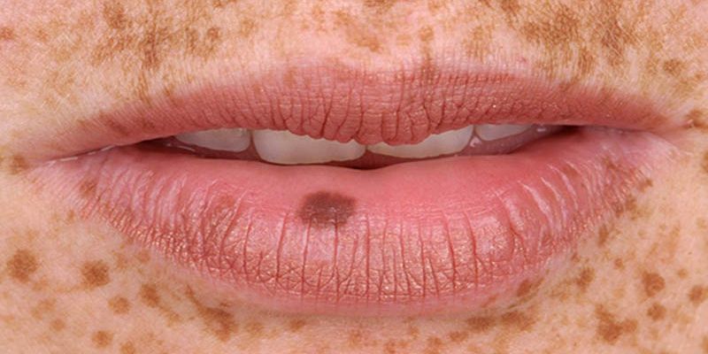 Cách điều trị nám da vùng miệng từ trong ra ngoài hiệu quả