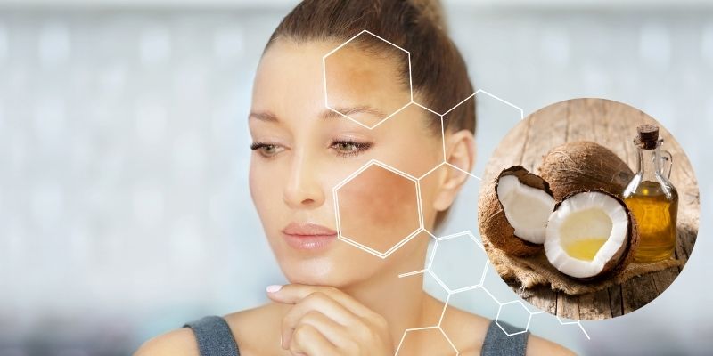 Trị tàn nhang bằng dầu dừa